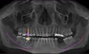 Sirona Galileos Comfort 3D CBCT 15x15 FOV avec PC, Garantie