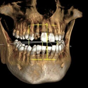 ICAT Next Gen 2D 3D CBCT Pan، 23x17 FOV مع الكمبيوتر الشخصي، ضمان