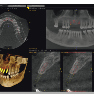 Carestream CS9300 Premium 2D 3D CBCT Pan 17x13,5 FOV mit Garantie