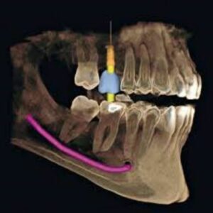 Sirona XG 2D 3D CBCT 8x8 FOV con PC, Garantía