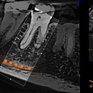 Carestream CS9300 Premium 2D 3D CBCT Pan 17x13,5 FOV con Garantía