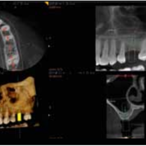 Carestream CS9300 Premium 2D 3D CBCT Pan 17x13,5 FOV avec Garantie