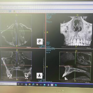 PreXion Eclipse XP77 2D 3D CBCT Pan Ceph 11.3x7.5 FOV مع الكمبيوتر الشخصي، ضمان