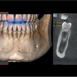 NewTom Giano HR Prime 2D 3D CBCT Pan 10x8 FOV mit Garantie