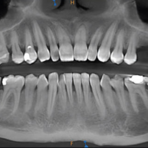 iCAT Precise 2D 3D CBCT 14x8 FOV con PC, Garantía