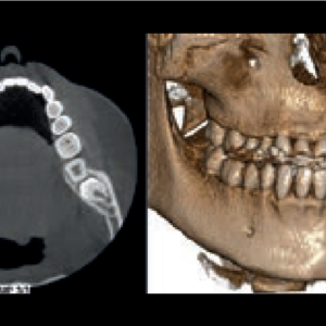 NewTom Giano HR Prime 2D 3D CBCT Pan 10x8 FOV مع الضمان