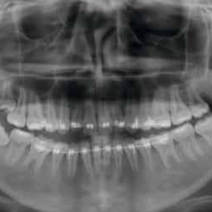 2018 Acteon XMind Trium 2D 3D CBCT Digital Pan 11x8 FOV مع الضمان