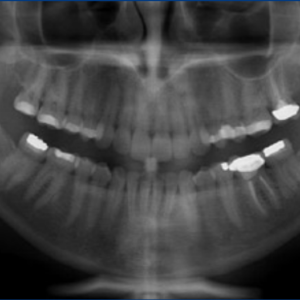 Gendex (iCAT) CB-500 2D 3D CBCT Pan 14x8 FOV مع الكمبيوتر الشخصي، ضمان