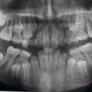 2018 Acteon XMind Trium 2D 3D CBCT Digital Pan 11x8 FOV مع الضمان