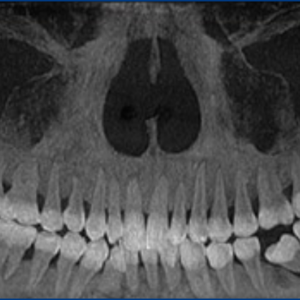 Gendex (iCAT) CB-500 2D 3D CBCT Pan 14x8 FOV مع الكمبيوتر الشخصي، ضمان