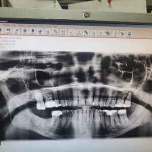 Vatech PaX Duo 2D 3D CBCT Pan FOV 12x8.5 مع الكمبيوتر الشخصي، ضمان