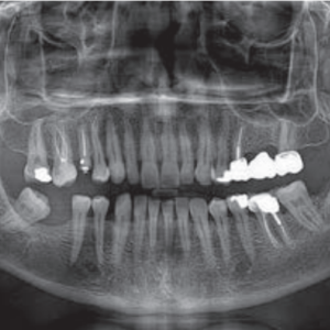 NouveauTom Giano HR Prime 2D 3D CBCT Pan 10x8 FOV avec Garantie