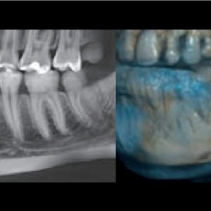 NewTom Giano HR Prime 2D 3D CBCT Pan 10x8 FOV con garantía