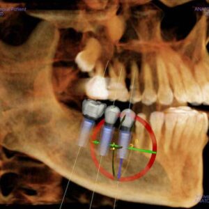 iCAT Precise 2D 3D CBCT 14x8 FOV avec PC, Garantie