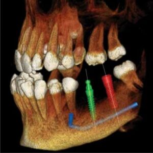 PreXion Eclipse XP77 2D 3D CBCT Pan Ceph 11.3x7.5 FOV مع الكمبيوتر الشخصي، ضمان