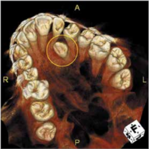 PreXion Eclipse XP77 2D+3D+CBCT Pan + Ceph 11.3x7.5 FOV mit PC, Garantie