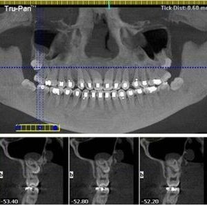 ICAT Next Gen 2D 3D CBCT Pan, 23x17 FOV avec PC, Garantie