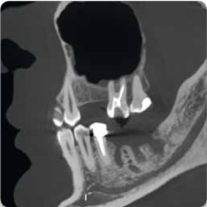 2018 Acteon XMind Trium 2D 3D CBCT Digital Pan 11x8 FOV مع الضمان