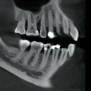 PreXion Eclipse XP77 2D 3D CBCT Pan Ceph 11.3x7.5 FOV مع الكمبيوتر الشخصي، ضمان