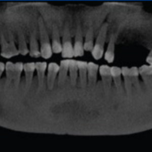 Gendex (iCAT) CB-500 2D 3D CBCT Pan 14x8 FOV مع الكمبيوتر الشخصي، ضمان