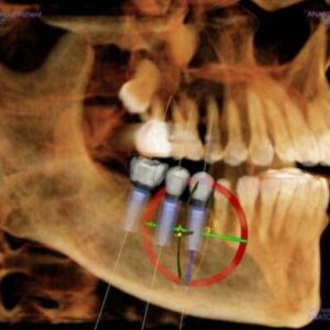 ICAT Next Gen 2D 3D CBCT Pan, 23x17 FOV avec PC, Garantie