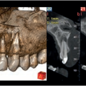 NewTom Giano HR Prime 2D 3D CBCT Pan 10x8 FOV mit Garantie