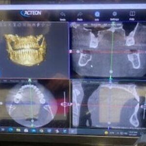 2018 Acteon XMind Trium 2D 3D CBCT Digital Pan 11x8 FOV مع الضمان